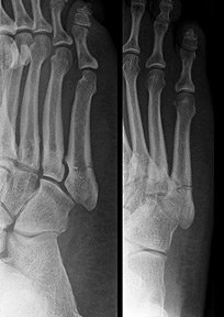 Jones fracture