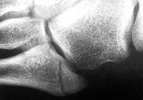 Avulsion fracture