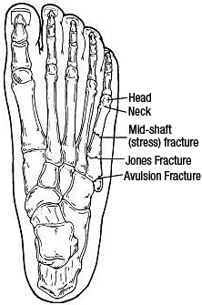 fracture