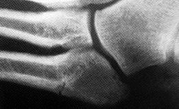 Jones type II fracture